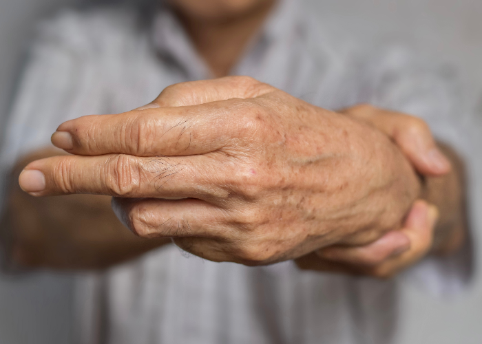 Hombre con rigidez en las manos, uno de los primeros síntomas de la artritis en las manos.  Hombre con rigidez en las manos, uno de los primeros síntomas de la artritis en las manos.